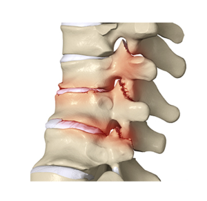 Arthritis-of-the-spine