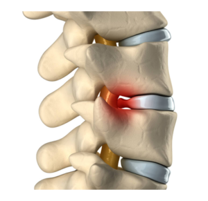 Herniated-Disc