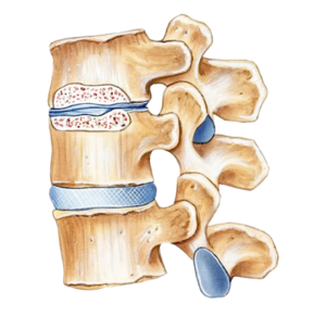 Spinal-Stenosis