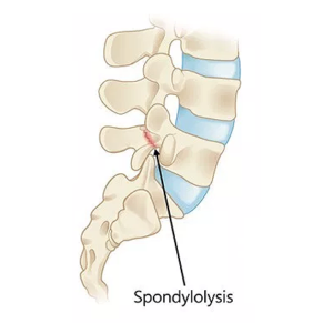 Spondylolysis