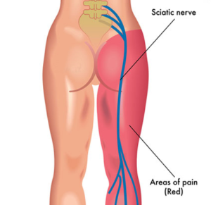 Sciatica